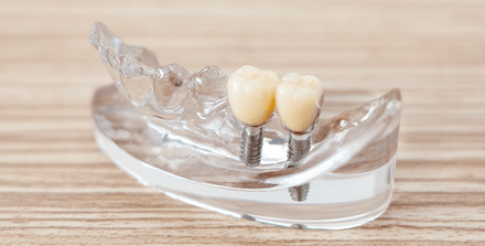 インプラント治療の様子